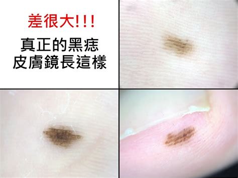 腳趾縫突然長痣|腳趾10年黑斑》是痣還是黑色素細胞瘤？ 5面向自我檢。